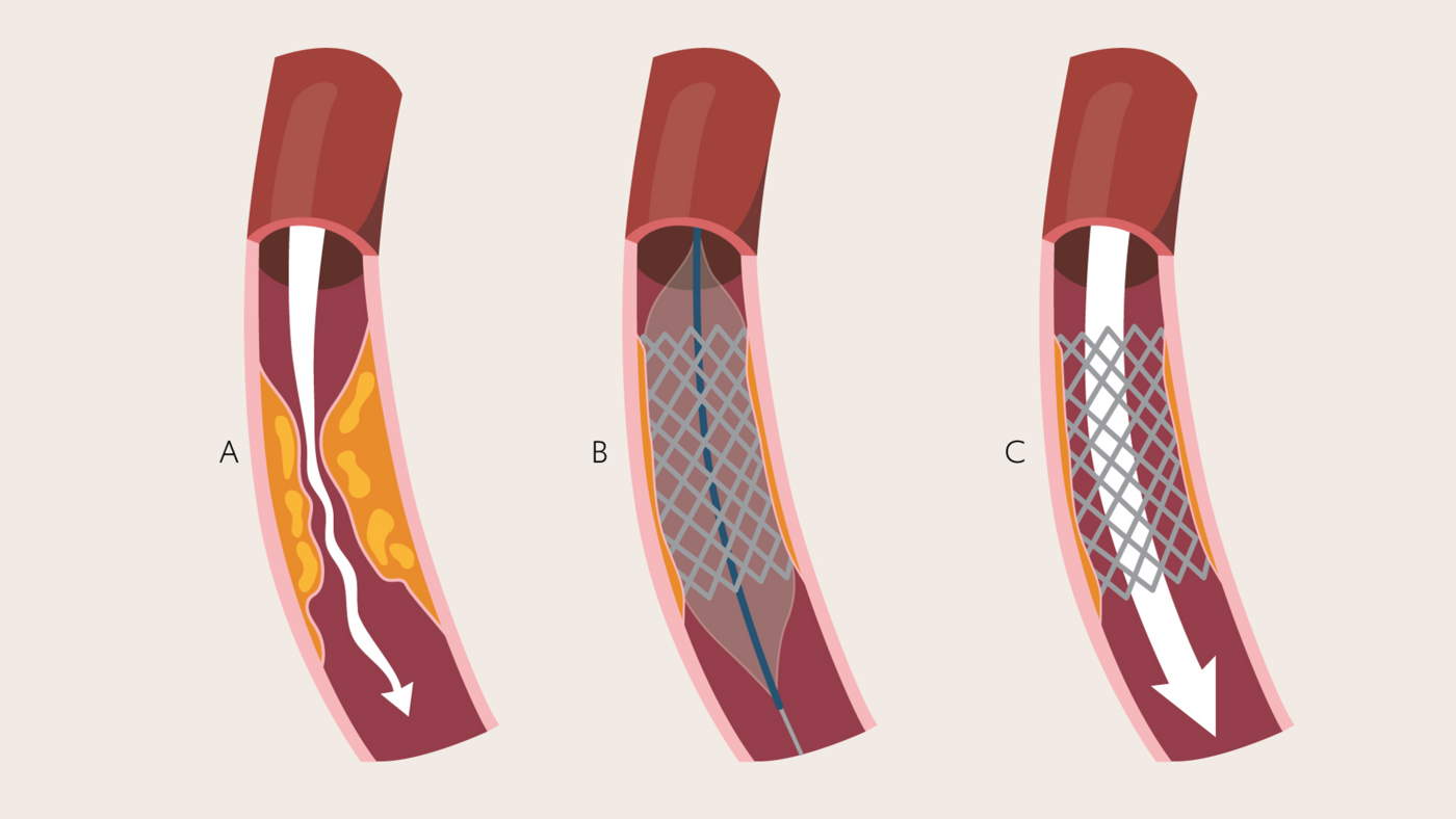 An illlustration showing the use of stenting to treat coronary heart disease.